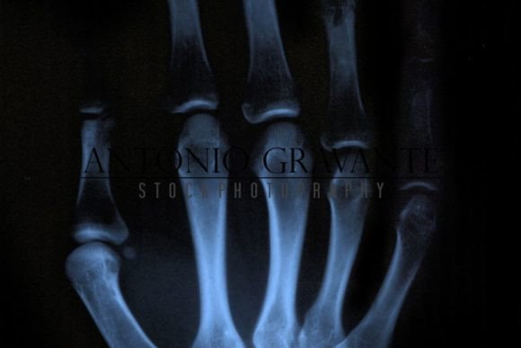 X-ray Hand Graphic Health By AntonioGravante